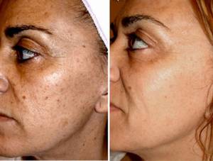 Ipl, Photofacial, dark spots, melasma, hyperpigmentation, vascular lesions, washington dc , georgetown, Dupont Circle, Capitol Hill, Medical Cosmetic