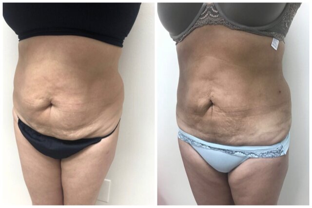Renuvion, J-Plasma for skin tightening. tummy tuck, Medical Cosmetic in Washington dc , Dupont Circle , Georgetown also Bethesda Maryland and Arlington Virginia