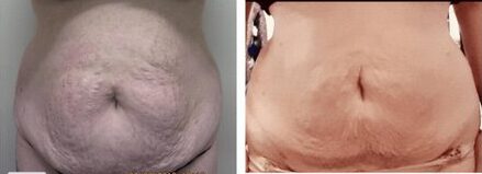 Renuvion, J-Plasma for skin tightening. tummy tuck, Medical Cosmetic in Washington dc , Dupont Circle , Georgetown also Bethesda Maryland and Arlington Virginia