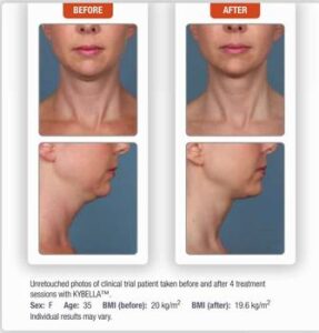 Kybella, Coolsculpting , double chin, neck liposcution MedicalCosmetic , Dupont Circle , Washington dc , Fat melting