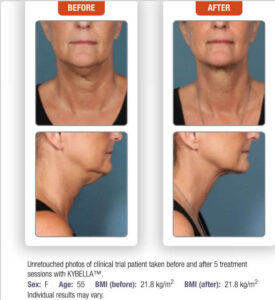 Kybella, Coolsculpting , double chin, neck liposcution MedicalCosmetic , Dupont Circle , Washington dc , Fat melting