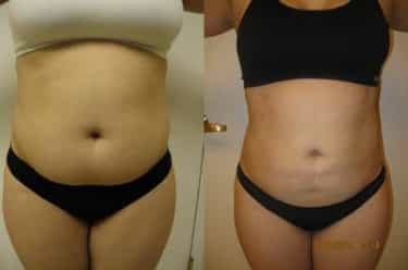Liposuction 360, Lipo, Laser Liposuction, J plasma, Washington DC , Dupont Circle, Georgetown, Abdomen Liposcution, Medical Cosmetic
