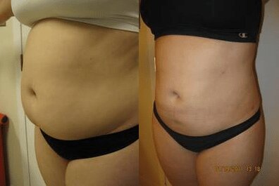 Liposuction 360, Lipo, Laser Liposuction, J plasma, Washington DC , Dupont Circle, Georgetown, Abdomen Liposuction, J plasma, Renuvion, skin tightening, Medical Cosmetic