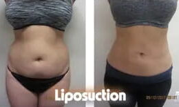 Liposuction 360, Lipo, Laser Liposuction, J plasma, Washington DC , Dupont Circle, Georgetown, Abdomen Liposuction, J plasma, Renuvion, skin tightening, Medical Cosmetic