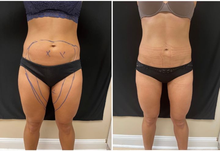 Liposuction 360, Lipo, Laser Liposuction, J plasma, Medical Cosmetic Dr. Drew Varano, Washington DC , Dupont Circle, Georgetown, Arlington Virginia, Bethesda, thigh Liposuction, inner thigh liposuction, outer thigh liposuction, liposuction,
