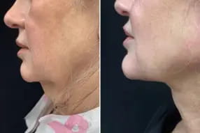 Renuvion lower face, renuvion submental neck, minimal invasive facelift, J plasma, Medical Cosmetic by Dr.Varano, Washington DC , Dupont Circle, Georgetown, serving Arlington Virginia, Bethesda, double chin liposuction