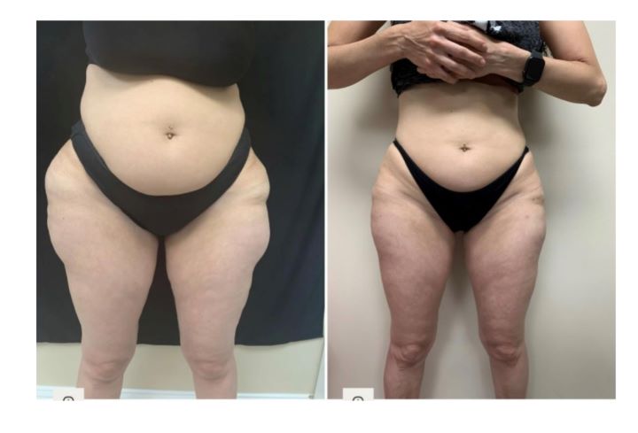 Liposuction 360, Lipo, Laser Liposuction, J plasma, Washington DC , Dupont Circle, Georgetown, Arlington, Bethesda, thigh Liposuction, inner thigh liposuction, outer thigh liposuction, liposuction, Medical Cosmetic