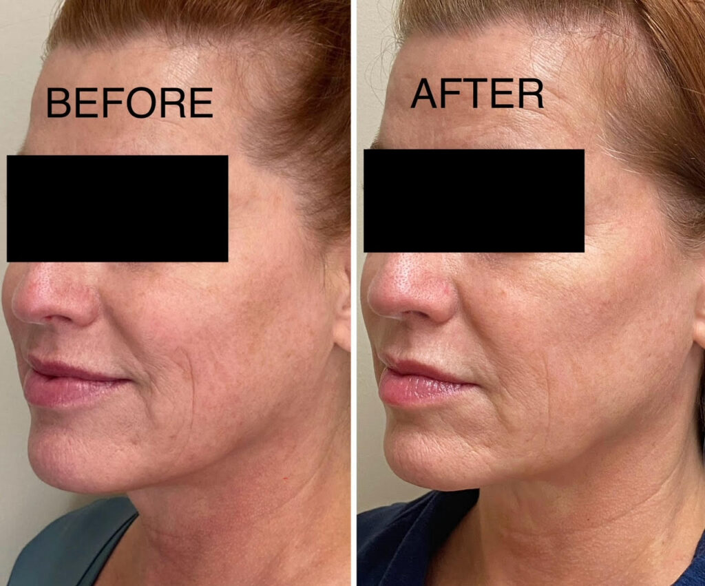 RF microneedling with Collagen induction therapy with Morpheus 8 for acne scars, tighten skin, under eyes, see us in Georgetown, Dupont circle, Bethesda Maryland, Arlington Virginia, washington dc, Medical Cosmetic