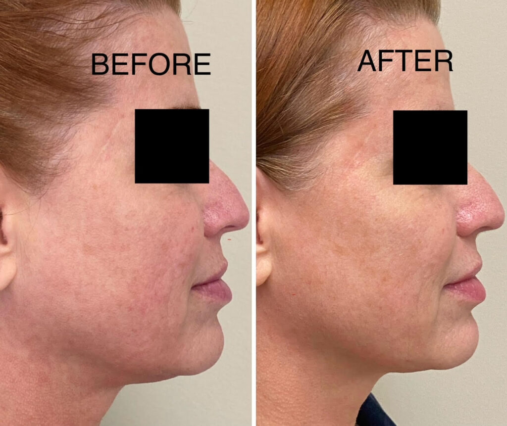RF microneedling with Collagen induction therapy with Morpheus 8 for acne scars, tighten skin, under eyes, see us in Georgetown, Dupont circle, Bethesda Maryland, Arlington Virginia, washington dc, Medical Cosmetic