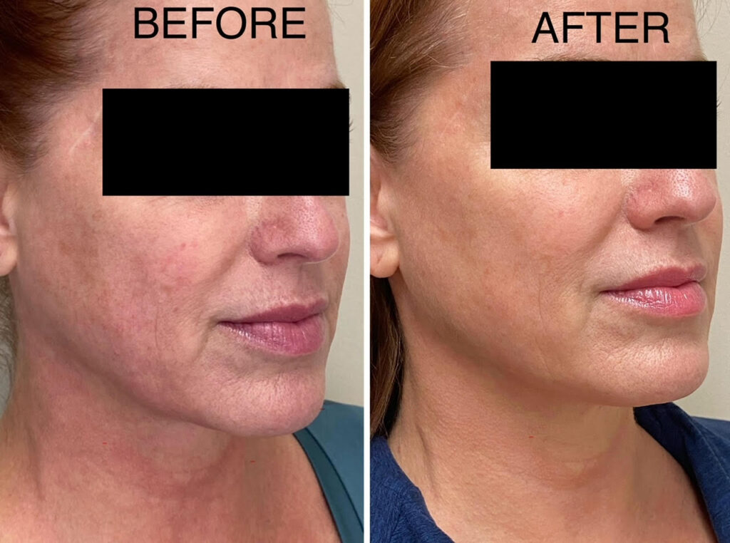 RF microneedling with Collagen induction therapy with Morpheus 8 for acne scars, tighten skin, under eyes, see us in Georgetown, Dupont circle, Bethesda Maryland, Arlington Virginia, washington dc, Medical Cosmetic