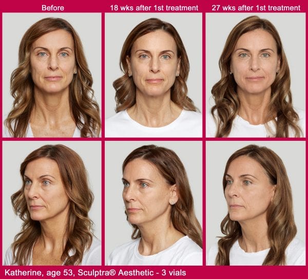 Sculptra for face, sculptra buttocks, dupont circle, washington dc , medical cosmetic