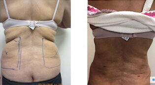 Renuvion, J-Plasma for skin tightening. tummy tuck, Medical Cosmetic in Washington dc , Dupont Circle , Georgetown also Bethesda Maryland and Arlington Virginia