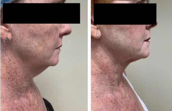 Liposuction 360, Lipo, Laser Liposuction, J plasma, Washington DC , Dupont Circle, Georgetown, Arlington, Bethesda, submental neck liposuction, double chin liposuction, Medical Cosmetic