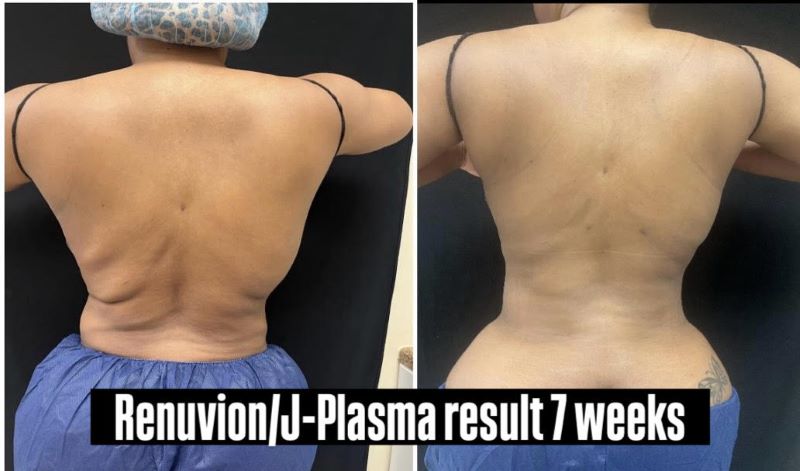 Renuvion, J-Plasma for skin tightening. tummy tuck, Medical Cosmetic in Washington dc , Dupont Circle , Georgetown also Bethesda Maryland and Arlington Virginia
