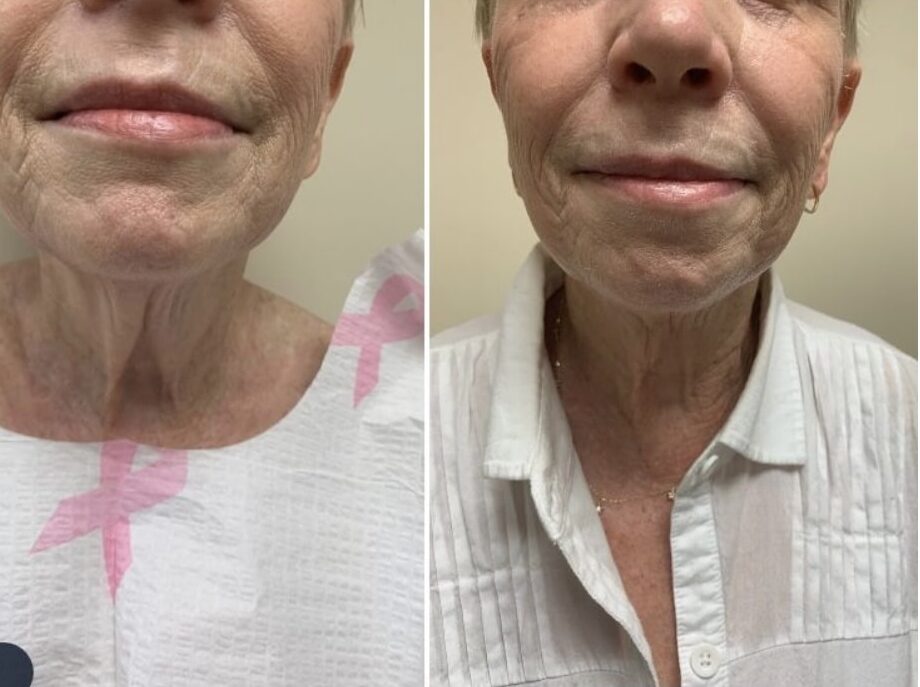 Liposuction 360, Lipo, Laser Liposuction, J plasma, Washington DC , Dupont Circle, Georgetown, Arlington, Bethesda, submental neck liposuction, double chin liposuction, Medical Cosmetic
