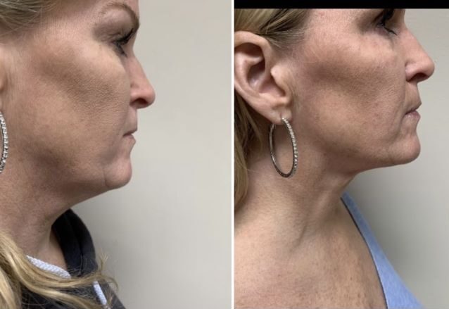 J plasma, Washington DC , Dupont Circle, Georgetown, Arlington, Bethesda, submental neck liposuction, double chin liposuction, Medical Cosmetic