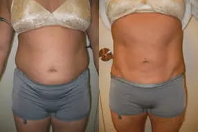Liposuction 360, Lipo, Laser Liposuction, J plasma, Medical Cosmetic, Dr. Drew Varano, Washington DC , Dupont Circle, Georgetown, Abdomen Liposuction, J plasma, Renuvion, skin tightening,
