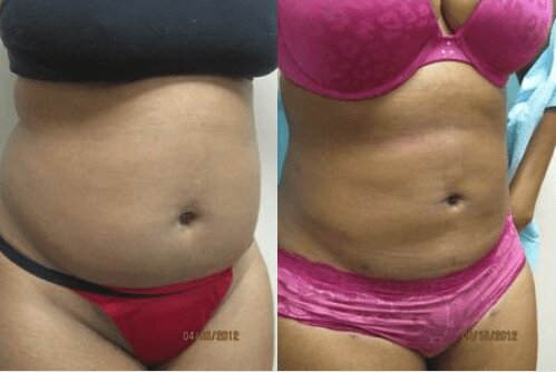 Liposuction 360, Lipo, Laser Liposuction, J plasma, Washington DC , Dupont Circle, Georgetown, Abdomen Liposuction, J plasma, Renuvion, skin tightening, Medical Cosmetic