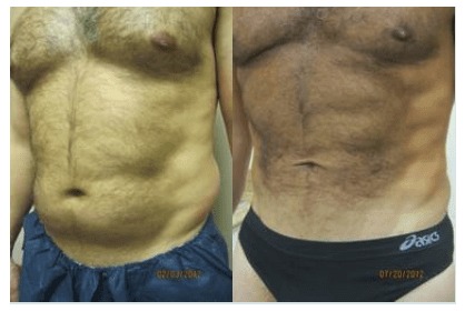 Liposuction 360, Lipo, Laser Liposuction, J plasma, Washington DC , Dupont Circle, Georgetown, Abdomen Liposuction, J plasma, Renuvion, skin tightening, Medical Cosmetic
