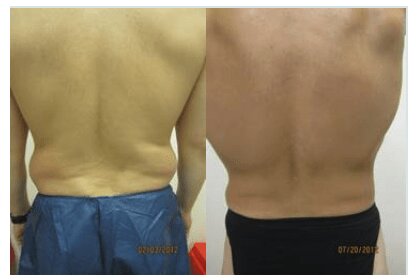 Liposuction 360, Lipo, Laser Liposuction, J plasma, Washington DC , Dupont Circle, Georgetown, Abdomen Liposuction, J plasma, Renuvion, skin tightening, Medical Cosmetic