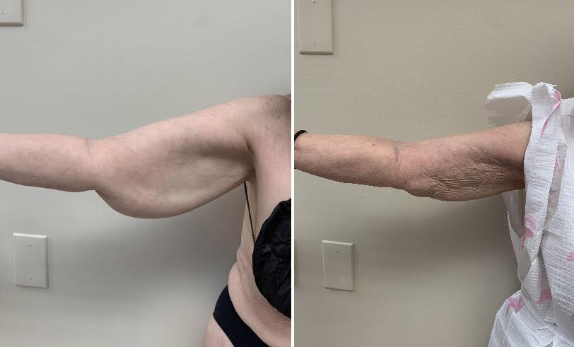 Renuvion, J-Plasma for skin tightening. tummy tuck and arm lift, Medical Cosmetic in Washington dc , Dupont Circle , Georgetown also Bethesda Maryland and Arlington Virginia