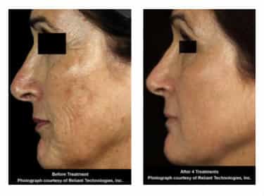 Fraxel , fractional co2 , washington dc, dupont circle, medical cosmetic, dr drew varano, washington dc, laser resurfacing, acne scars, melasma