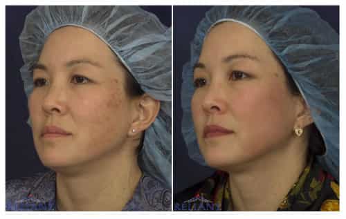 Fraxel , fractional co2 , washington dc, dupont circle, medical cosmetic, dr drew varano, washington dc, laser resurfacing, acne scars, melasma
