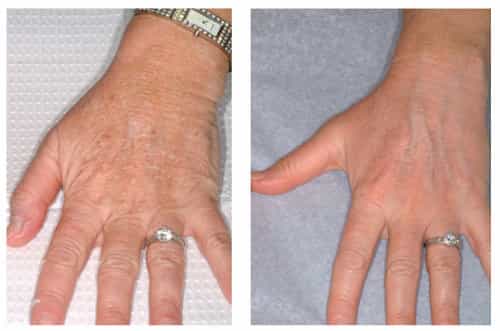 Fraxel , fractional co2 , treatment in washington dc, dupont circle at medical cosmetic by dr drew varano. laser resurfacing can treat Hands wrinkles and acne scars and melasma, stretch marks