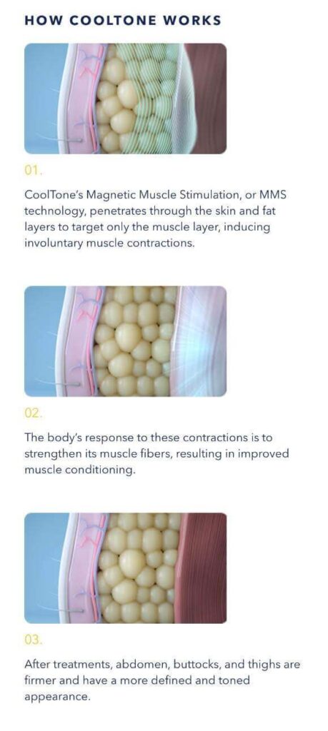 Cooltone Medical Cosmetic Washington DC BBL, muscle builder. Emsculpt, Dupont Circle