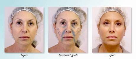 PDO thread, thread lift at Medical Cosmetic Washington DC , Dupont Circle, Georgetown, Arlington, Bethesda
