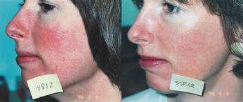 Ipl, Photofacial, dark spots, melasma, Roseaca, hyperpigmentation, vascular lesions, washington dc , georgetown, Dupont Circle, Capitol Hill, Medical Cosmetic