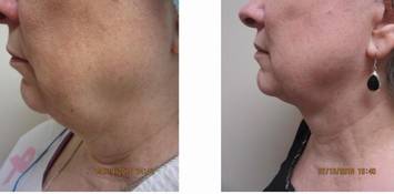 Renuvion, J plasma, Washington DC , Dupont Circle, Georgetown, Arlington, Bethesda, submental neck liposuction, double chin liposuction, Medical Cosmetic