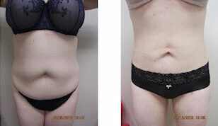 Renuvion, J-Plasma for skin tightening. tummy tuck, Medical Cosmetic in Washington dc , Dupont Circle , Georgetown also Bethesda Maryland and Arlington Virginia