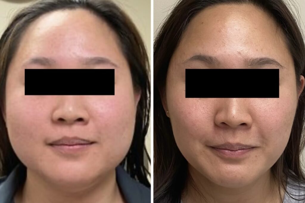 Jeuveau, Letybo, Botox , daxxify Medcial Cosmetic Washington DC Dupont circle masseter facial slimming