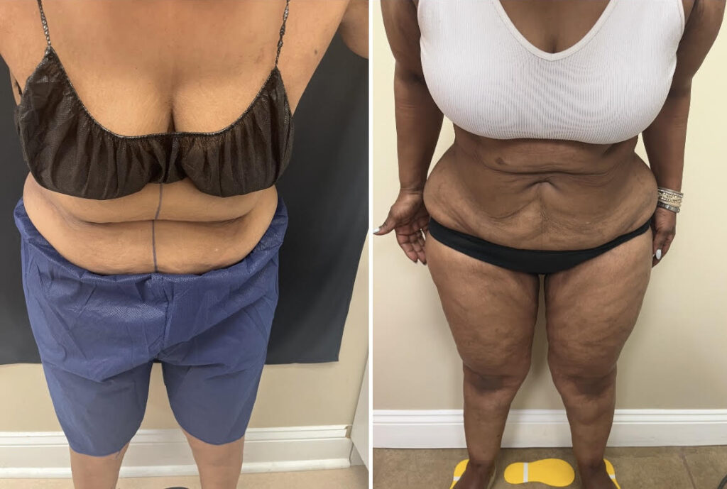Renuvion, J-Plasma for skin tightening. tummy tuck, Medical Cosmetic in Washington dc , Dupont Circle , Georgetown also Bethesda Maryland and Arlington Virginia