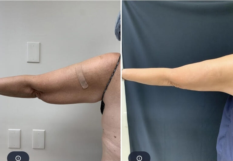 Liposuction 360, Lipo, Laser Liposuction, J plasma, Washington DC , Dupont Circle, Georgetown, Arm Liposuction, Medical Cosmetic