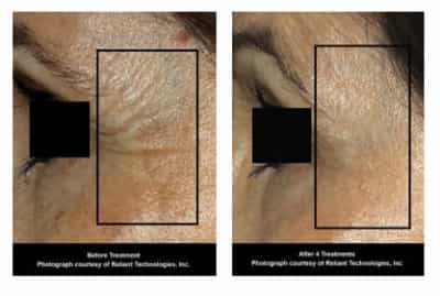 Fraxel , fractional co2 , washington dc, dupont circle, medical cosmetic, dr drew varano, washington dc, laser resurfacing, acne scars, melasma