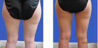 Coolsculpting elite thighs at Medical Cosmetic in washington dc near Dupont Circle and Georgetown