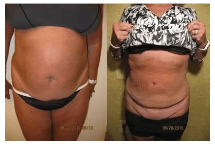 Liposuction 360, Lipo, Laser Liposuction, J plasma, Washington DC , Dupont Circle, Georgetown, Abdomen Liposuction, J plasma, Renuvion, skin tightening, Medical Cosmetic