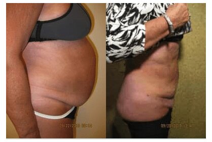 Liposuction 360, Lipo, Laser Liposuction, J plasma, Washington DC , Dupont Circle, Georgetown, Abdomen Liposuction, J plasma, Renuvion, skin tightening, Medical Cosmetic