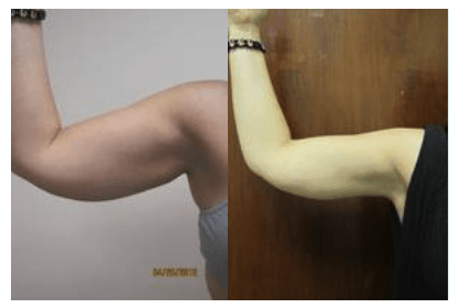 Liposuction 360, Lipo, Laser Liposuction, J plasma, Washington DC , Dupont Circle, Georgetown, Arm Liposuction, Medical Cosmetic