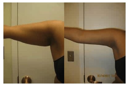 Liposuction 360, Lipo, Laser Liposuction, J plasma, Washington DC , Dupont Circle, Georgetown, Arm Liposuction, Medical Cosmetic
