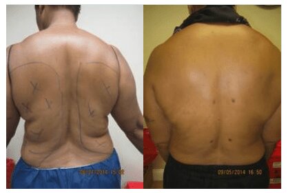 Liposuction 360, Lipo, Laser Liposuction, J plasma, Washington DC , Dupont Circle, Georgetown, Arlington, Bethesda, Back Liposuction, Bra roll liposuction, Medical Cosmetic