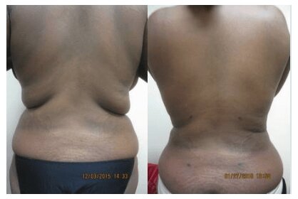 Liposuction 360, Lipo, Laser Liposuction, J plasma, Washington DC , Dupont Circle, Georgetown, Back Liposuction, Bra roll liposuction,Medical Cosmetic
