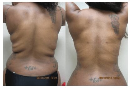 Liposuction 360, Lipo, Laser Liposuction, J plasma, Washington DC , Dupont Circle, Georgetown, Arlington, Bethesda, Back Liposuction, Bra roll liposuction, Medical Cosmetic