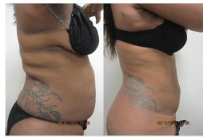 Liposuction 360, Lipo, Laser Liposuction, J plasma, Washington DC , Dupont Circle, Georgetown, Arlington, Bethesda, Back Liposuction, Bra roll liposuction, Medical Cosmetic