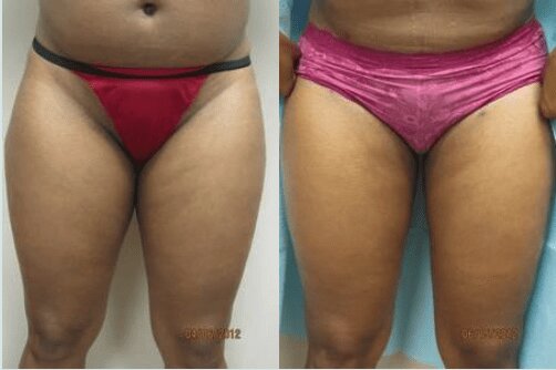 Liposuction 360, Lipo, Laser Liposuction, J plasma, Washington DC , Dupont Circle, Georgetown, Arlington, Bethesda, thigh Liposuction, inner thigh liposuction, outer thigh liposuction, liposuction, Medical Cosmetic