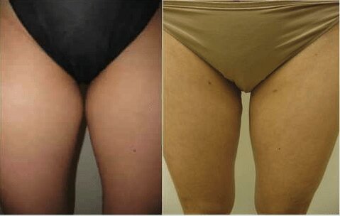 Liposuction 360, Lipo, Laser Liposuction, J plasma, Washington DC , Dupont Circle, Georgetown, Arlington, Bethesda, thigh Liposuction, inner thigh liposuction, outer thigh liposuction, liposuction, Medical Cosmetic
