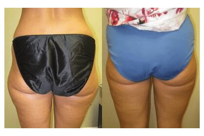 Liposuction 360, Lipo, Laser Liposuction, J plasma, Washington DC , Dupont Circle, Georgetown, Arlington, Bethesda, thigh Liposuction, inner thigh liposuction, outer thigh liposuction, liposuction, Medical Cosmetic