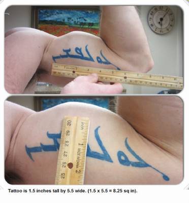 Laser Tattoo removal , Medical Cosmetic in Washington DC near Dupont Circle, Georgetown serving Arlington Virginia and Maryland
